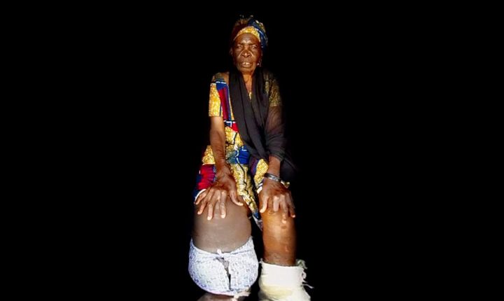 A woman with severe elephantiasis, a disease that -- if left untreated -- can cause irreversible swelling of the limbs.