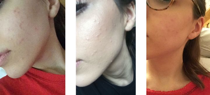 The Simple Skin Care Routine That Helped Me Get Rid Of My Hormonal