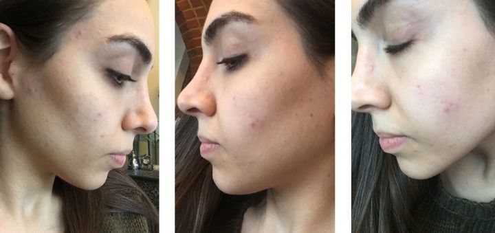 <em>Skin a week before taking tablet and beginning skincare regime.</em>