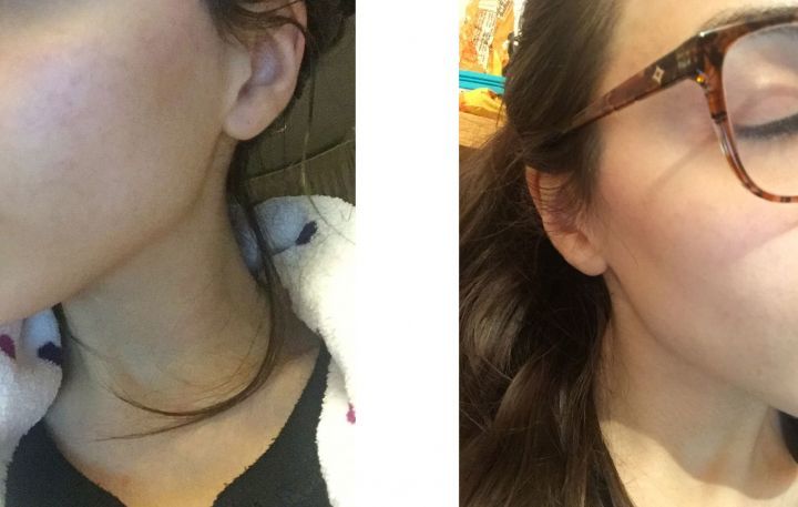 <em>Clear skin: day 6 and day 7.</em>