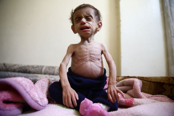 Hala al-Nufi, 2 1/2 years old, suffers from a metabolic disorder which is worsening due to the siege and food shortages in the eastern Ghouta.