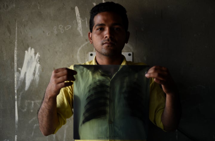 Indian tuberculosis patient Sonu Verma, 25, poses with his chest X-ray on March 3, 2016.