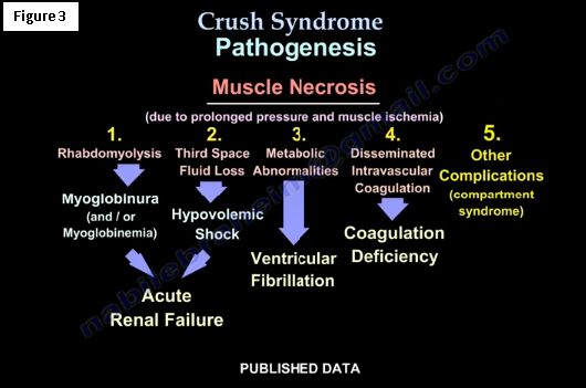 Syndrom crush Amputation in