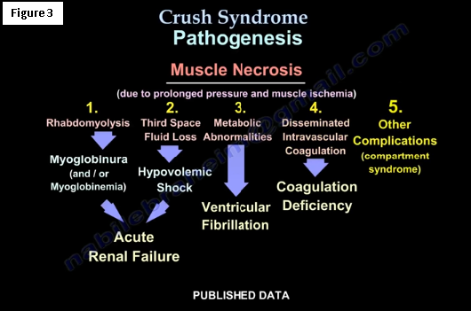 Crush Syndrome —