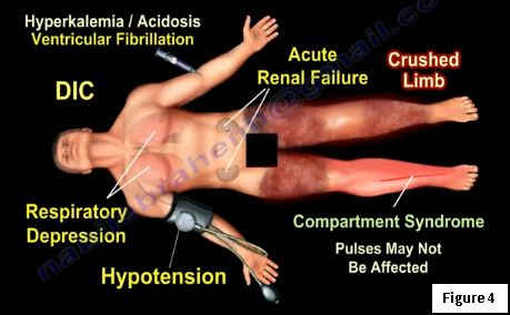 A Crush Injury - RCEMLearning India