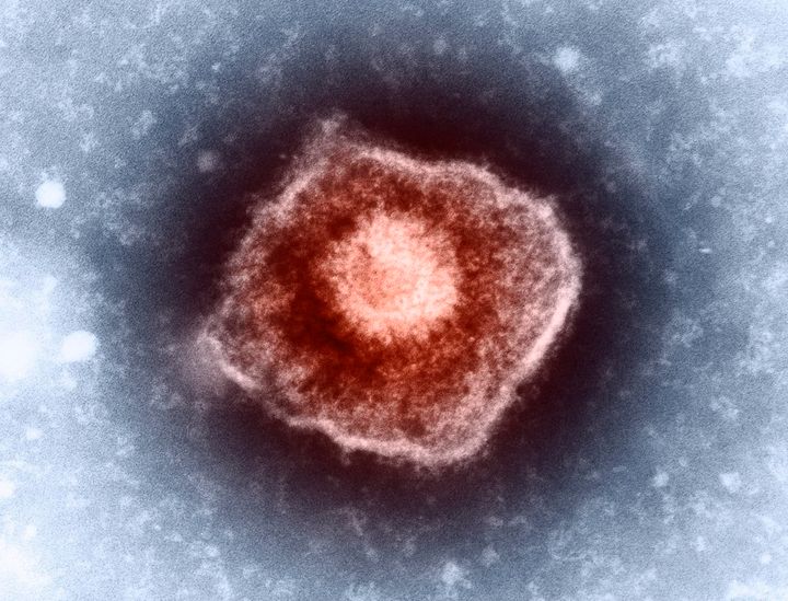 An electron micrograph of the varicella zoster virus, which causes both chicken pox and shingles.