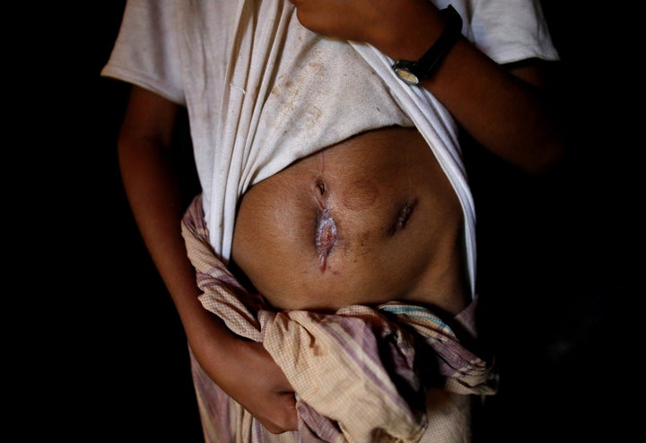 Mohammad Shobaik, 12, a Rohingya refugee boy who said he was shot by the military during an attack on his village in Myanmar,