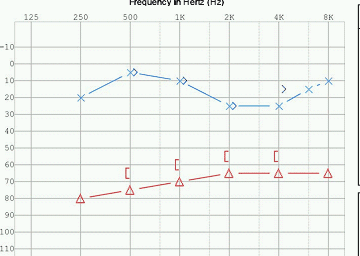 Characteristic hearing loss pattern (blue) of late-stage Meniere’s disease.