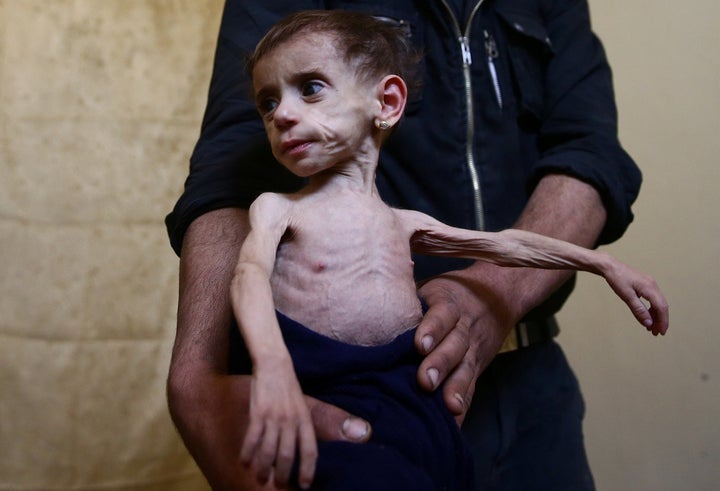 Hala al-Nufi, 2, shown here on Oct. 25, suffers from a metabolic disorder that is worsening due to the siege and food shortages in Syria's eastern Ghouta.