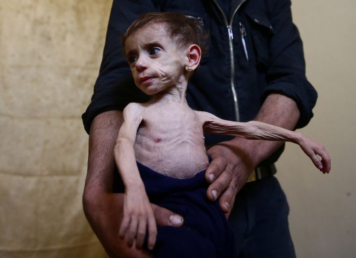 Hala al-Nufi, 2, shown here on Oct. 25, suffers from a metabolic disorder that is worsening due to the siege and food shortages in Syria's eastern Ghouta. 