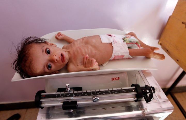 A malnourished Yemeni child receives treatment at a hospital in the capital Sanaa on November 22, 2017.