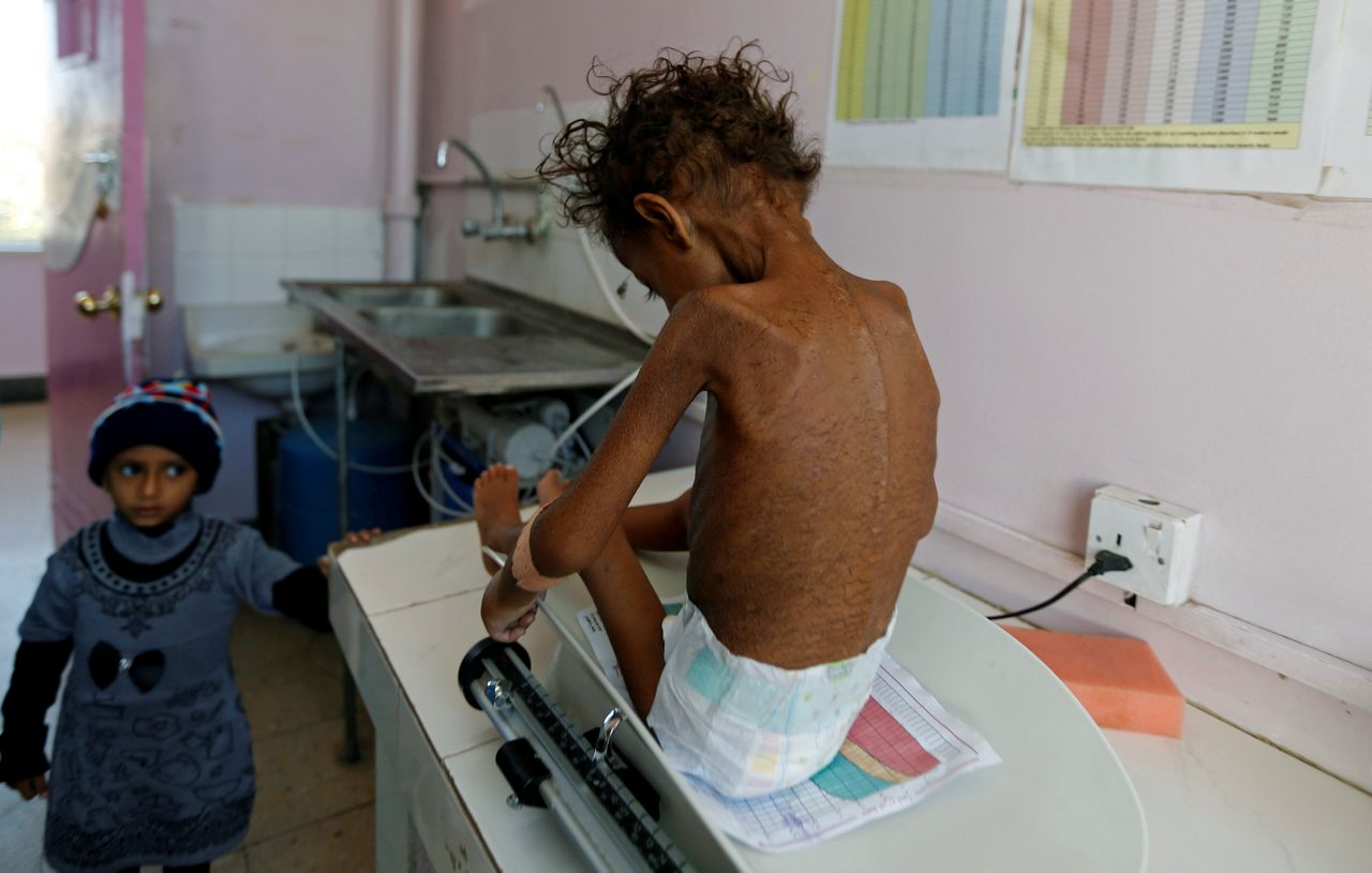 A five-year-old girl sits on a scale at a malnutrition treatment center in Sanaa, Yemen, on Nov. 22, 2017.