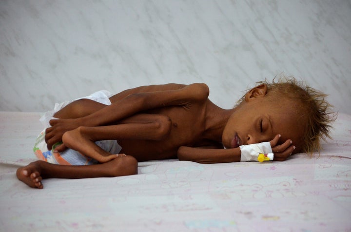 A malnourished 6-year-old lies in a bed at an intensive care unit in the Yemeni city of Hodeidah on Sept. 11, 2016.