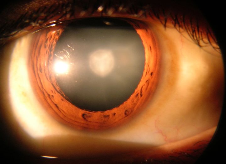 Magnified eye with cataract