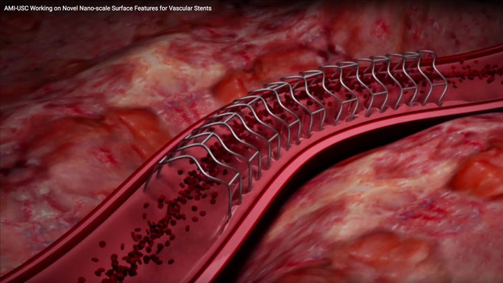 <p>Nano-scale surface features for vascular stents</p>