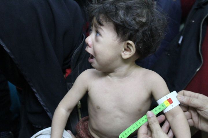 A child is screened and shown to be severely malnourished in Al Kahef hospital near Damascus in October