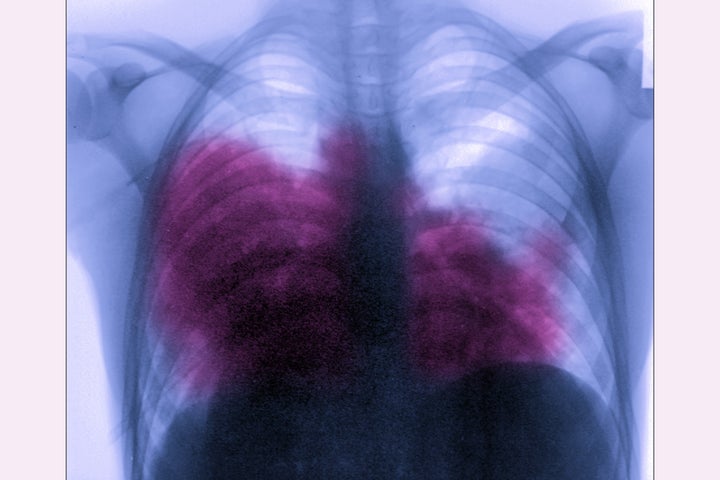 Acute bilateral pneumonia, aka Legionnaires' disease, is seen on a chest X-ray.