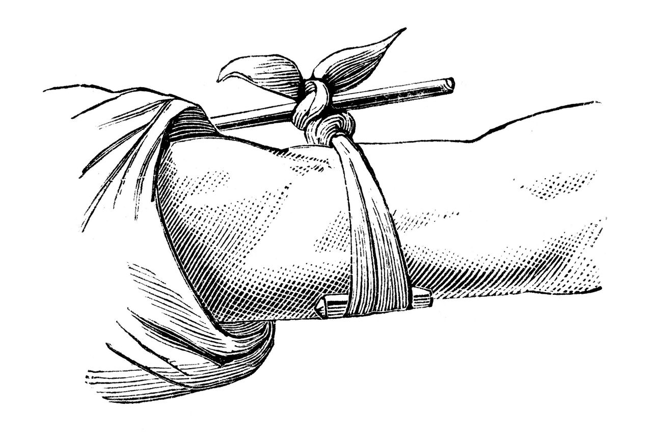 A Victorian-era etching of a tourniquet. 