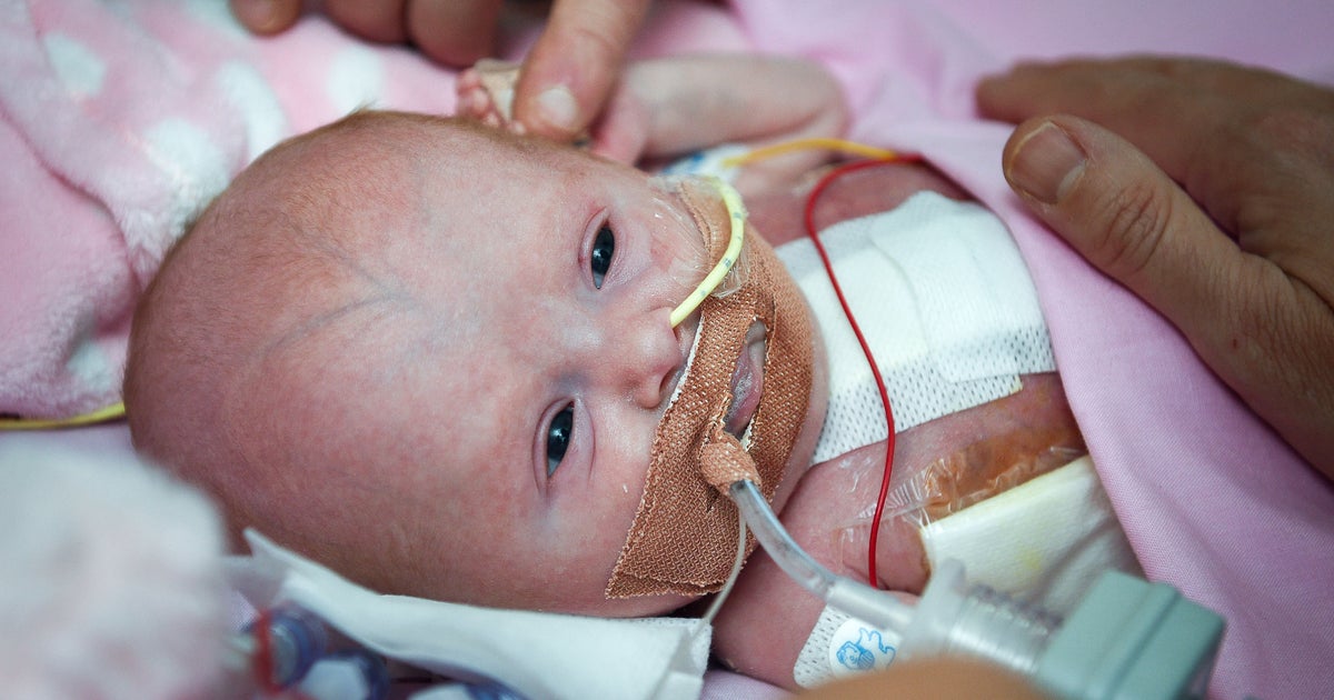 Vanellope: Baby Born With Heart Outside Her Body Survives Rare ...