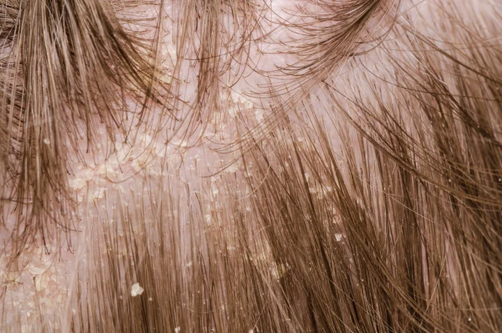 What Is The Difference Between Dandruff And Dry Scalp Huffpost Life