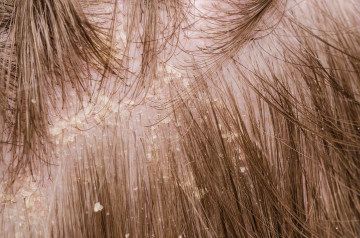 Flaking of the scalp.