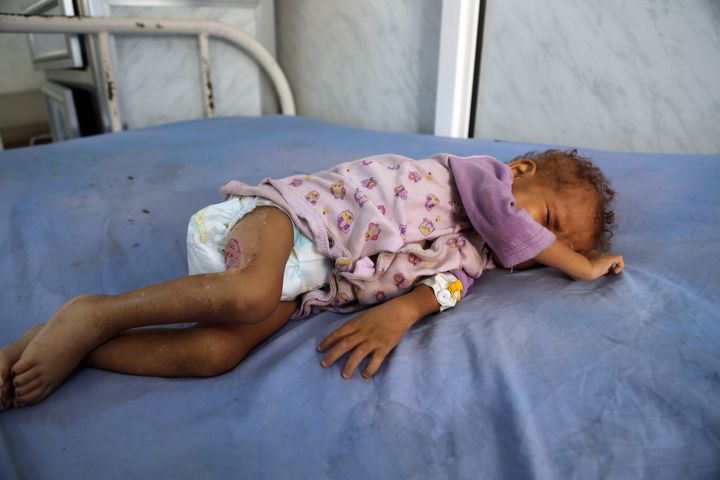 A malnourished Yemeni child receiving treatment at hospital 