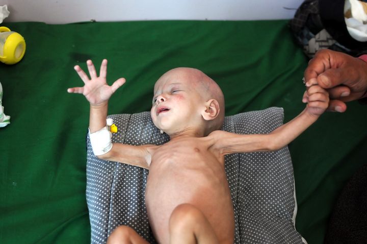 Millions of people in Yemen are on the brink of starvation. Pictured: A malnourished baby receives hospital treatment 