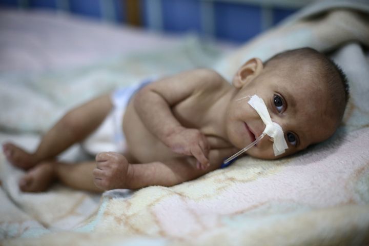 A nine-month old baby suffering malnutrition in Eastern Ghouta, Syria