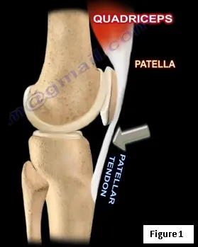 Patellar Tendon Rupture - Everything You Need To Know - Dr. Nabil