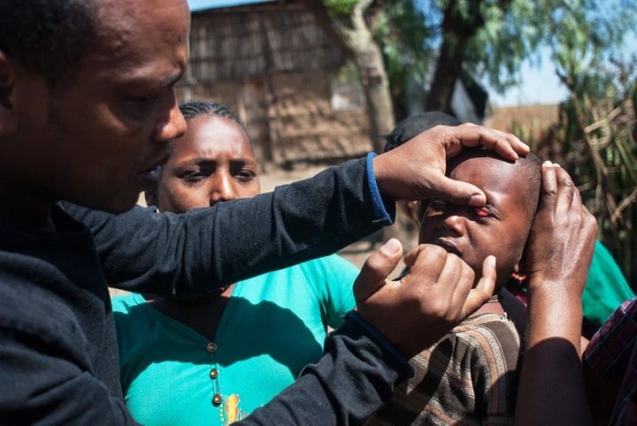 Muluadam Abraham, an ophthalmic nurse, examines a small child for signs of trachoma, finding white spots on the inside of the eyelid that indicate infection.