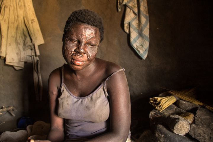 Abalo Vicky, 21, fell into a fire during a nodding syndrome seizure last year and was badly burned.