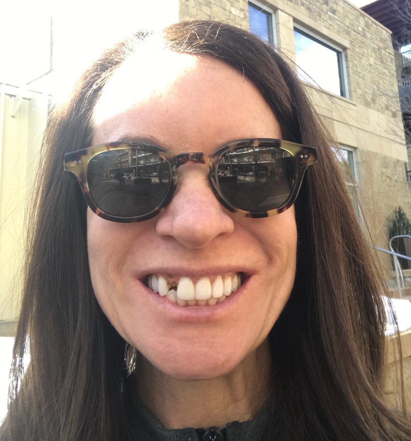 Dental emergency! Here’s my oh-so-dazzling smile right after the protein-bar incident.
