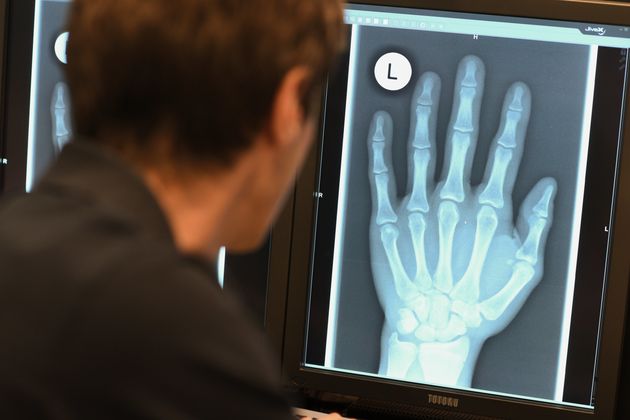 Ein Radiologe schaut sich am 12.01.2018 in Friedrichshafen (Baden-Württemberg) im Röntgenbild die linke Hand eines 17-Jährigen an.