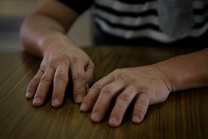 Oo Boon Siew's hands, which he says still experience joint pains due to chikungunya.