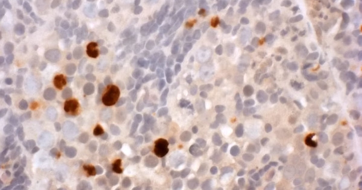 Ibuprofen In Early Pregnancy Could Harm Daughters' Future Fertility