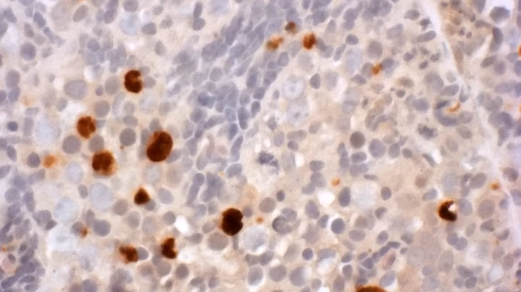 Ibuprofen In Early Pregnancy Could Harm Daughters' Future Fertility