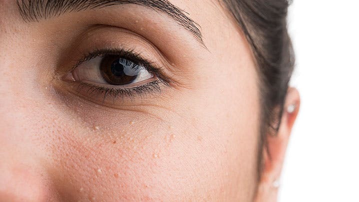 What S The Deal With Those Small White Bumps On Your Face HuffPost   5a81fd191e0000df007ab779 