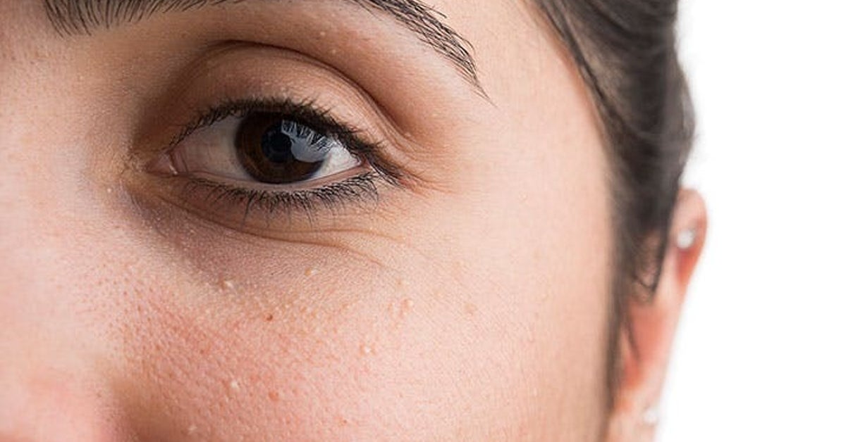 What’s The Deal With Those Small White Bumps On Your Face? HuffPost Life