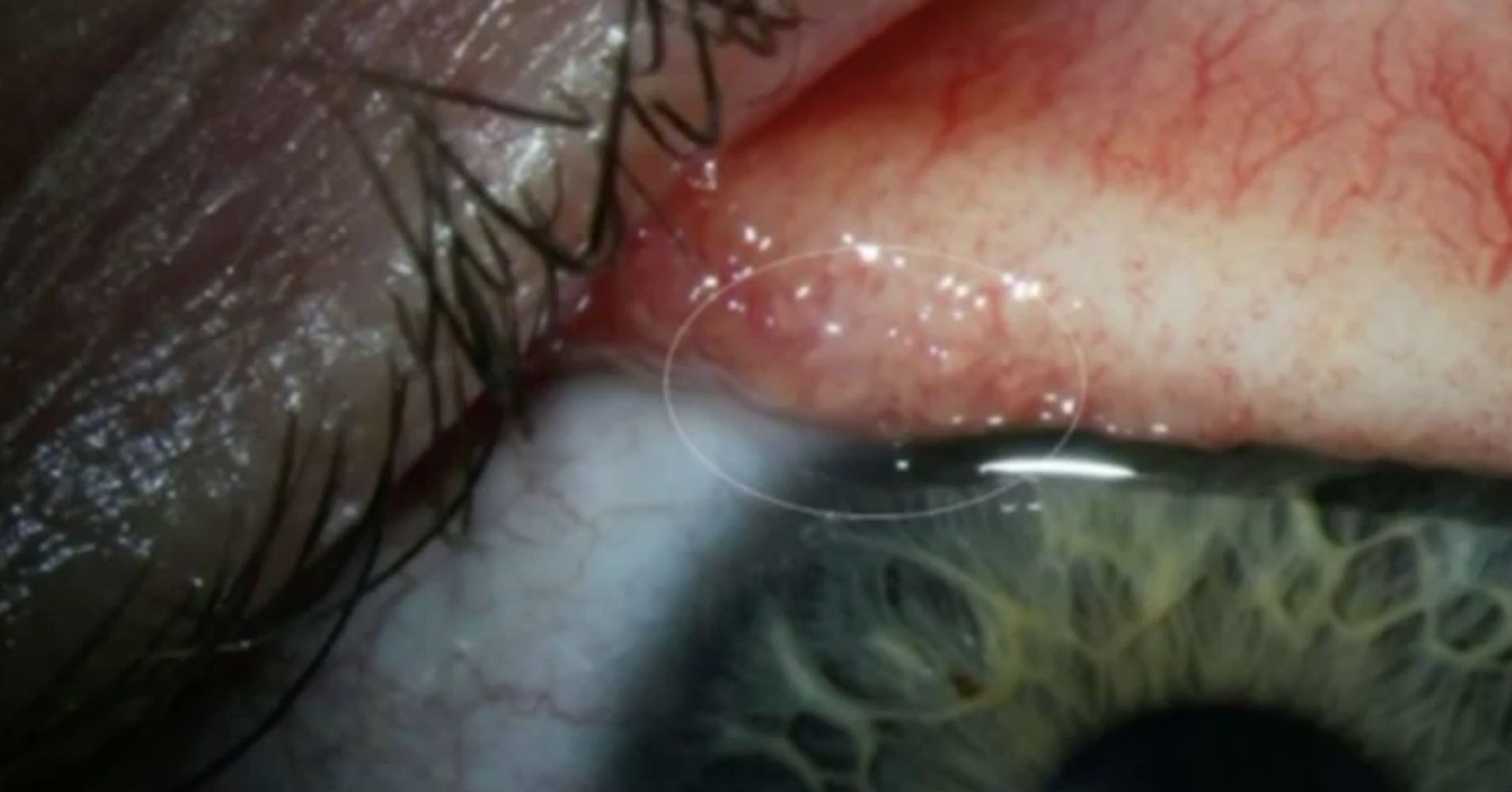 14 Worms Removed From Oregon Woman's Eye | HuffPost