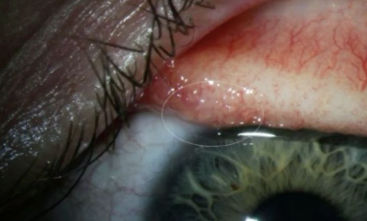 An Oregon woman found herself infected with 14 parasitic worms in her eyeballs.