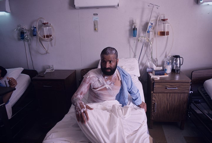 A victim of Saddam Hussein's chemical gas attack on Halabja.