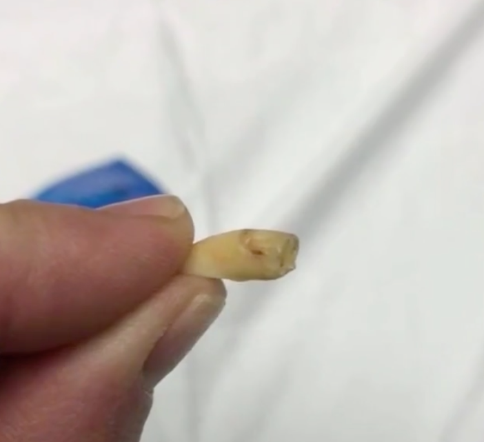 Nickolette Botsford claims she found this blood-covered tooth in a bag of Planters cashews.