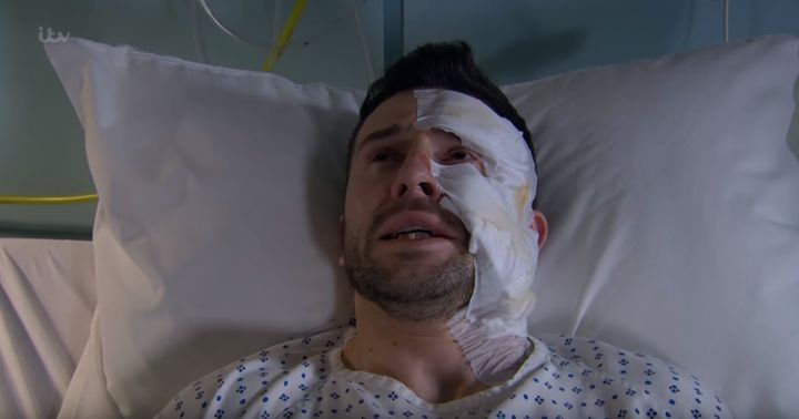 Ross Barton has been left scarred following an acid attack in 'Emmerdale'