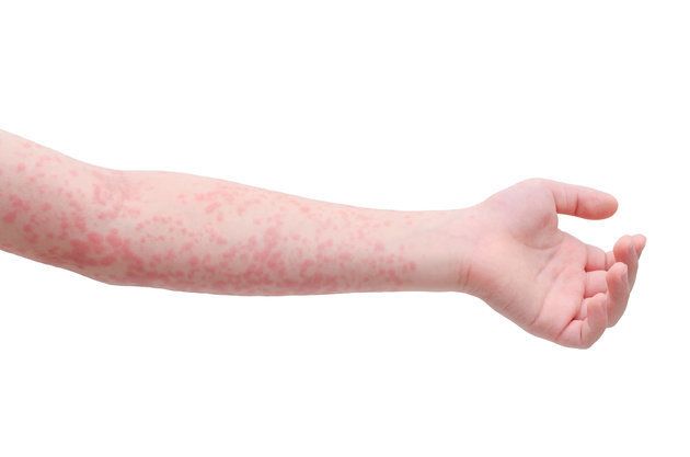 A scarlet fever rash.