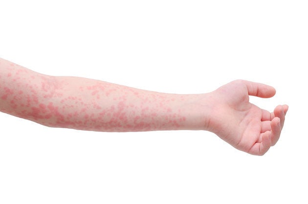 Scarlet Fever Signs And Symptoms In Children As Cases On The Rise In  Scotland