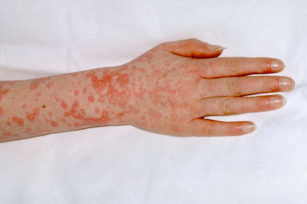 Scarlet Fever Signs And Symptoms In Children After Cases Hit 50 Year   5aba05d51e00008e0b7afd6d 