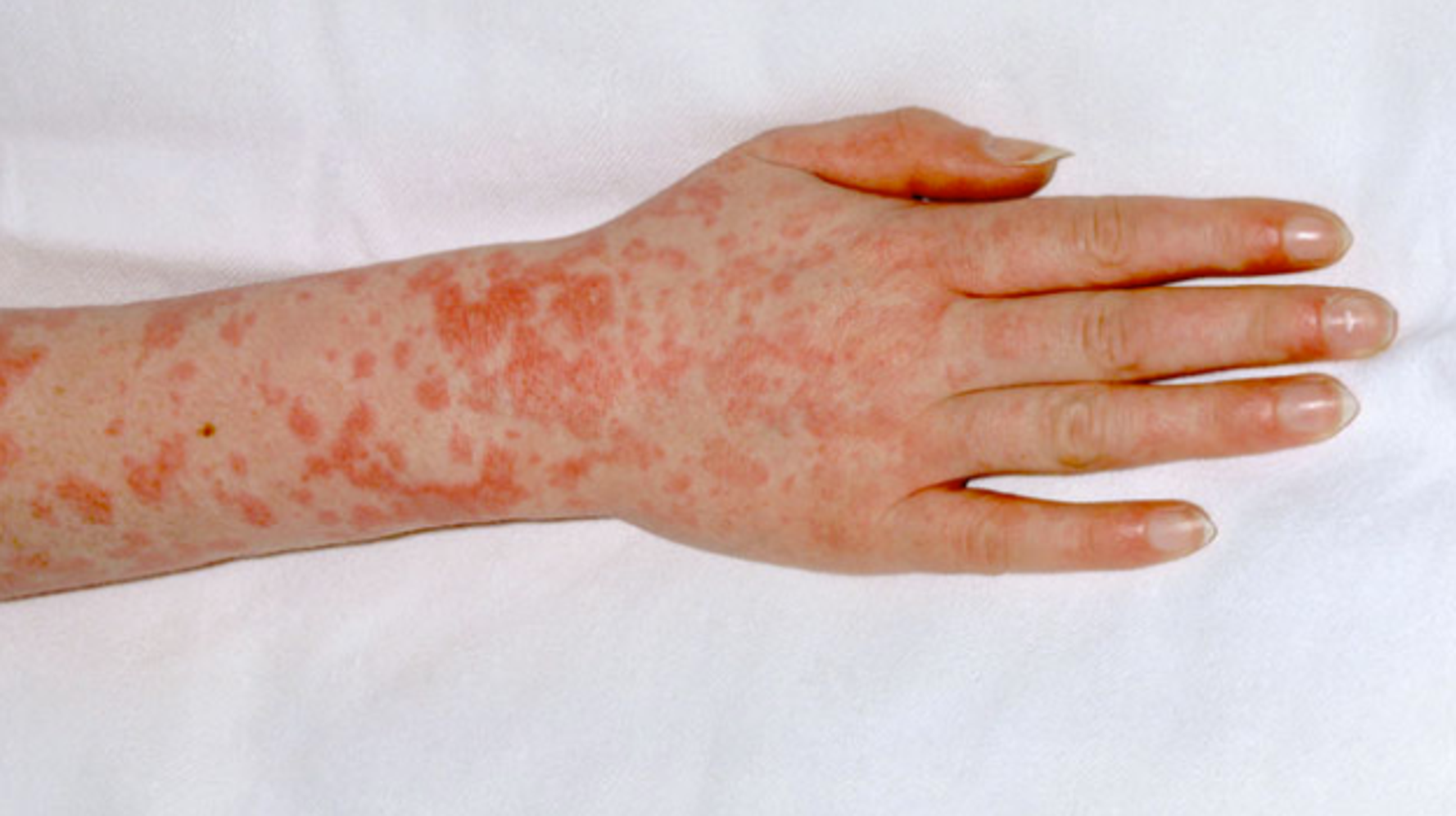 Scarlet fever - Wikipedia