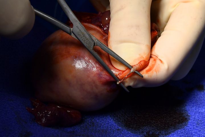 Dr. Paul J. MacKoul shows how the Essure device has adhered inside Melissa Gilbert's fallopian tubes, which he removed along with her uterus.
