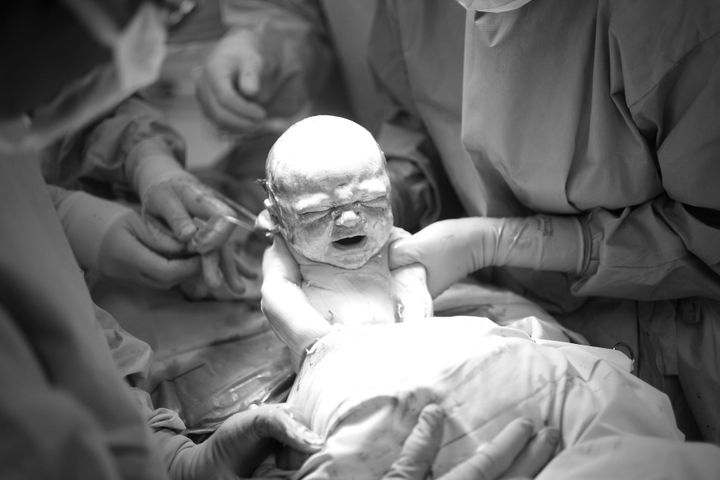 Some are concerned about rising C-section rates.