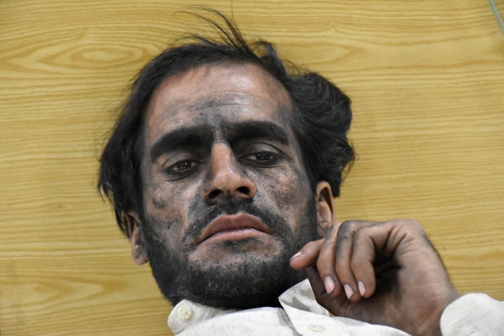 A worker, who survived after a coal mine explosion in Marwar area, rests at a hospital in Quetta, Pakistan, on May 5, 2018. (